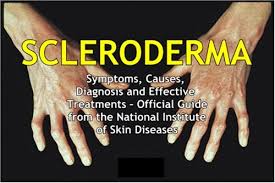 Scleroderma is a chronic disease that causes the skin to become thick and hard, a buildup of scar tissue, and damage to internal organs . Scleroderma Symptoms Causes Diagnosis And Effective Treatments Official Guide From The National Institute Of Skin Diseases English Edition Ebook National Institute Of Skin Diseases Department Of Health And Human Services