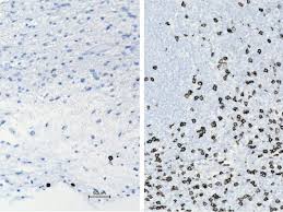 Some children with brain tumors show minimal lasting effects on health and function after treatment. Unusual Treatment Shows Promise For Kids With Brain Tumours Americas Gulf News
