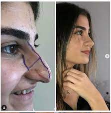 Biggest & most modern plastic surgery clinic in baltic states, team of 6 plastic surgeons Nose Job Before After 2021 Liposuction Before And After Nose Job Nose Contouring Nose Reshaping