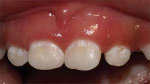 In this article, learn more about gum abscesses and how to. Clinical Practice Guidelines Dental Conditions Non Traumatic