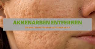 Bilder sagen mehr als tausend worte! Aknenarben Entfernen á… Die Besten Methoden Auf Einen Blick