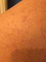 Skin Concern 13 Year Old Brother Has Large Pores On Back And Neck Is This A Potential Food Allergy Or Just Regular Bacne Bacne Large Pores Skin Concern