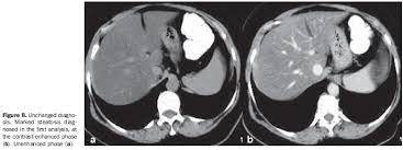 Unenhanced Ct Scan Meaning Ct Scan Machine