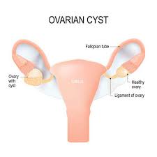 Symptoms can include an abrupt onset of severe pelvic pain, nausea and vomiting. Ovarian Cysts Astra Laparoscopic Robotic Centre For Women And Fertility