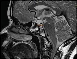 Pituitary Stalk Interruption Syndrome Case Report Of Three Cases With Review Of Literature Gutch M Kumar S Razi Sm Saran S Gupta Kk J Pediatr Neurosci
