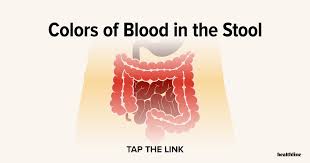 Image result for Blood in stool