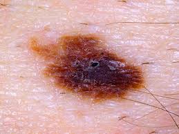 Carrie madormo, rn, mph, is a freelance health writer with over a decade of experience working as a reg. Is It Skin Cancer Cbs News