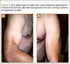Build muscle at any age with these muscle building and strength training tips and feel younger and energetic again. Isolated Brachialis Muscle Atrophy Mdedge Surgery