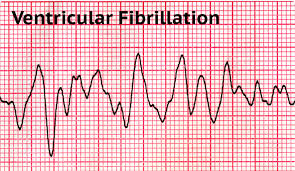 Image result for Ventricular Fibrillation