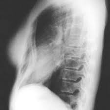 Pectus Excavatum Eurorad