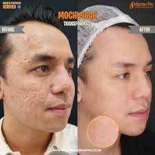 Mochi Scar™️ membuat kulit wajah lembut, cerah, bebas kerutan, dan dapat  mengatasi kulit yang berjerawat dan scar pada wajah 🔸 Treatment: Mochi  Scar™️ 🔸 Fungsi: Melembabkan kulit wajah, membuat wajah cerah merona