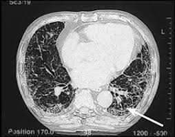 ct scans and mris for mesothelioma analysis. Asbestos Related Lung Disease American Family Physician