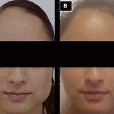 Fotografía clínica. A: inicial, aumento de volumen facial izquierdo,...