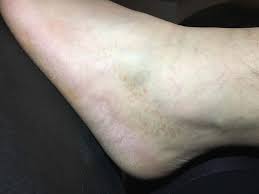 Image result for brown patches on the feet