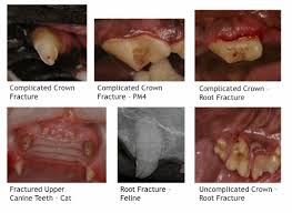 Image result for Tooth Fracture