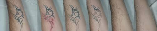 With modern advances in tattoo removal technology, dermatology and skin black and other dark pigments in a tattoo are the easiest to remove, while lighter colors can be a little more difficult. Laser Tattoo Removal Results And Issues The Pmfa Journal