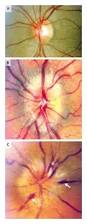 Image result for Optic Neuritis