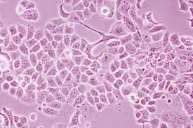 There are many other reasons why a woman would experience post menopausal bleeding when bleeding after menopause can be a sign of endometrial cancer. Aromatase Inhibitors Reduce Breast Cancer Deaths