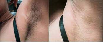 Do you want truly painless laser hair removal? Laser Hair Removal Philadelphia Permanent Hair Removal Pa