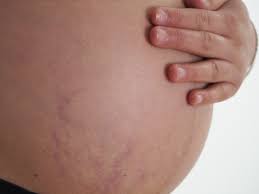 Streifen Am Bauch Ursachen Behandlung Vorbeugung Gesundpedia De