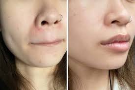 We did not find results for: 5 Girls Tried La Roche Posay S Effaclar Serum To See If They Could Get Smooth Clear Even Skin After 1 Month Zula Sg