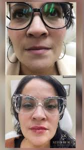 Thoughtful planning > rushing results 🧠💉 This lip enhancement was  completed over three treatments to support tissue adaptation and achieve a  soft, natural outcome 👄✨ Swipe to see where we started and