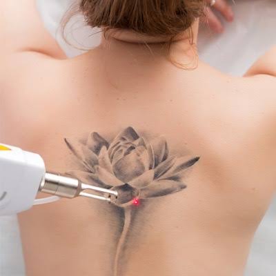 PicoSure Tattoo Removal in Dubai - Laser Skin Care Clinic
