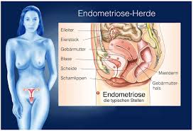 Eierstockschmerzen Symptome Ursachen Und Behandlung Heilpraxis