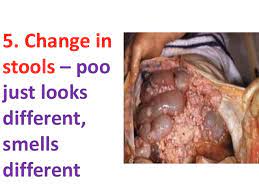 Bleeding from your bottom and/or. Symptoms Of Colon Colorectal Cancer In Men Women