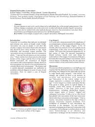 Image result for Sublingual Varices