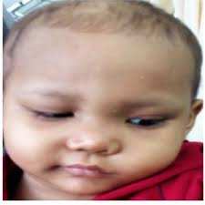 PDF) Burkitt's lymphoma of nasal cavity and bilateral maxillary sinuses