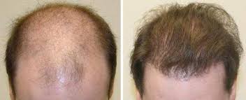 Descrizione, costi, foto prima e dopo. Trapianto Di Capelli Le 7 Cose Da Sapere