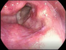 Image result for Reflux Laryngitis