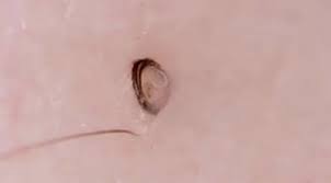 See more ideas about ingrown hair, underarm hair, ingrown hair remedies. Help I Can T Stop Watching These Crazy Ingrown Hair Removal Videos Ingrown Hair Removal Ingrown Hair Ingrown Hair Armpit