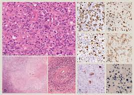 I was recently diagnosed with gray zone lymphoma. Grey Zones In The Differential Diagnosis Of Lymphoma Pathology Sciencedirect
