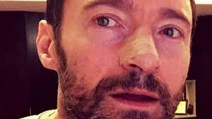 Exfoliating the skin on the face is a good way to remove dead skin cells. Hugh Jackman Has Skin Cancer Removed On Nose And Posts Sun Safety Warning Bbc News