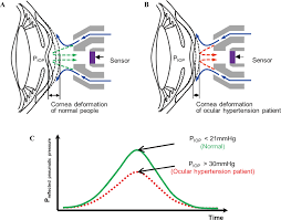 Image result for Intraocular Pressure