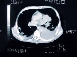 A cough associated with a cold or respiratory infection will go away in. Lung Cancer Imaging In Asymptomatic Patients To Screen Or Not To Screen Pulmonology Advisor