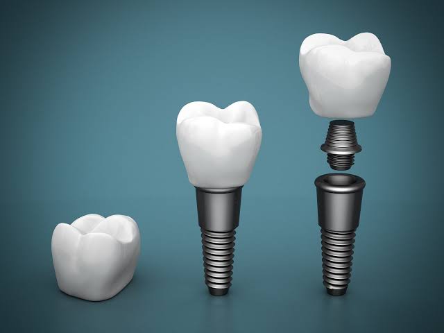 Replacing Teeth | Surgical Implant Placement