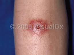Do you have a spider bite? Spider Bite