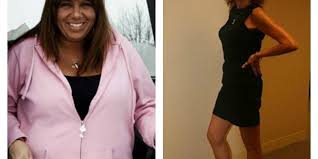 After a gastric bypass, all patients are carefully instructed in what to eat and how to eat. Weight Loss Surgery Before And After Photos Health Travel Guide