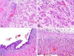 Each tumor specimen was reviewed by three pathologists (k.i., y.t., and k.k.). Malignant Peritoneal Mesothelioma In Patients With Endometriosis Journal Of Clinical Pathology