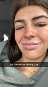 Swollen Eyelids Mono