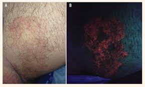 Image result for Erythrasma