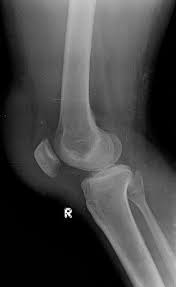 Image result for Prepatellar Bursitis