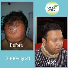 Indian Hair Transplant