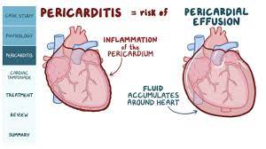 Since april, the cdc has seen a spike in reports of myocarditis along with pericarditis, an inflammation of the membrane around the heart. Pericardial Disease Pathology Review Osmosis