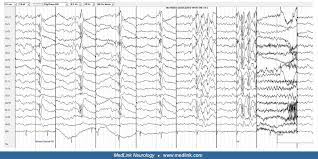 Baca that man's epilepsy / baca that man's epilepsy : Eeg In Epilepsy Medlink Neurology