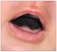 Image result for black hairy tongue symptoms