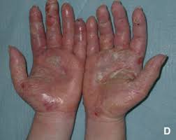 Image result for dermatitis contacta allergica